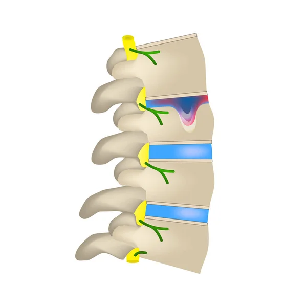 Hernia Schmorl. Cakram intervertebral. Sisi tampilan. Tulang belakang. Ilustrasi Vektor Infografis pada latar belakang terisolasi - Stok Vektor
