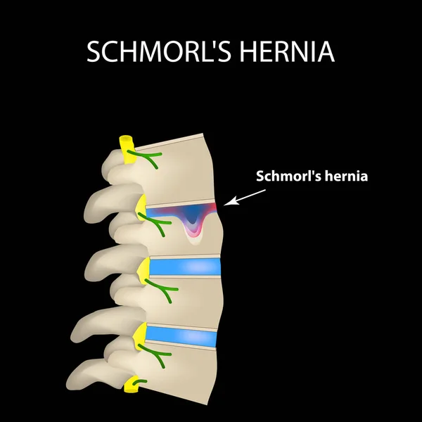 Hernia Schmorl. Disco intervertebrale. Vista laterale. Colonna vertebrale. Infografica. Illustrazione vettoriale su sfondo nero — Vettoriale Stock