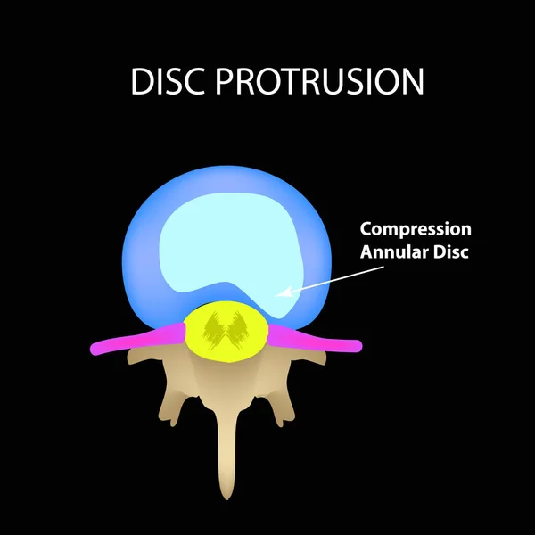 Disc protrusion. Top view. Spine. Infographics. Vector illustration on a black background — Stock Vector