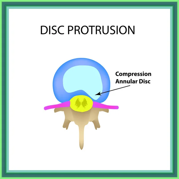 Disc protrusion. Top view. Spine. Infographics. Vector illustration on isolated background — Stock Vector
