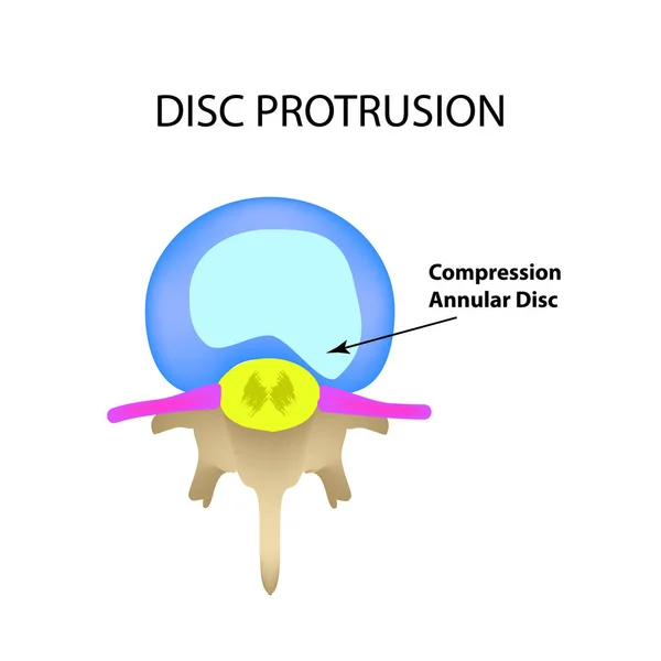 Protrusión de disco. Vista superior. Espina dorsal. Infografías. Ilustración vectorial sobre fondo aislado — Archivo Imágenes Vectoriales