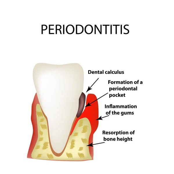 Periodontite. doença dentária. Inflamação das gengivas e da pedra dos dentes. Infográficos. Ilustração vetorial sobre fundo isolado — Vetor de Stock