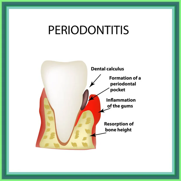 Periodontite. doença dentária. Inflamação das gengivas e da pedra dos dentes. Infográficos. Ilustração vetorial sobre fundo isolado — Vetor de Stock