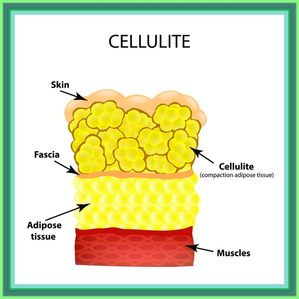 Κυτταρίτιδα. Η ανατομική δομή του λιπώδους ιστού. Τα γραφήματα. Εικονογράφηση διάνυσμα σε απομονωμένες φόντο — Διανυσματικό Αρχείο