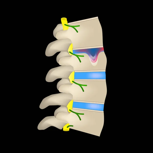 Hernia Schmorl. Cakram intervertebral. Sisi tampilan. Tulang belakang. Infografis. Ilustrasi vektor pada latar belakang hitam - Stok Vektor