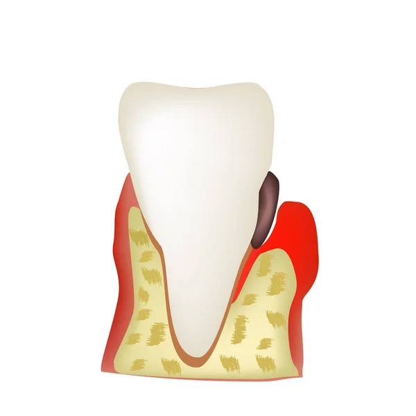 Parodontite. malattia dentale. Infiammazione delle gengive e della pietra dentaria. Infografica. Illustrazione vettoriale su sfondo isolato — Vettoriale Stock