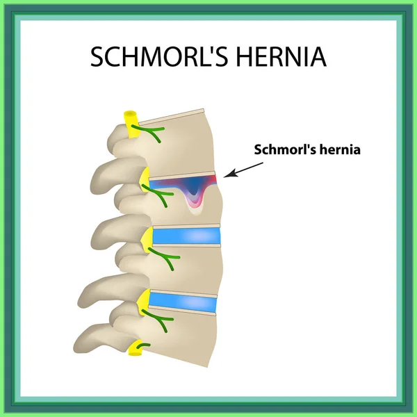 Hernia Schmorl. Intervertebral disc. Side view. Spine. Infographics Vector illustration on isolated background — Stock Illustration Hernia Schmorl. Intervertebral disc. Side view. Spine. Infographics Vector illustration on isolated background Royalty Free Stock Illustrations