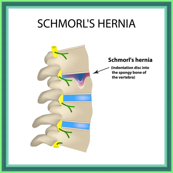 Hernia Schmorl. Intervertebral disc. Side view. Spine. Infographics Vector illustration on isolated background — Stock Illustration Hernia Schmorl. Intervertebral disc. Side view. Spine. Infographics Vector illustration on isolated background Vector Graphics