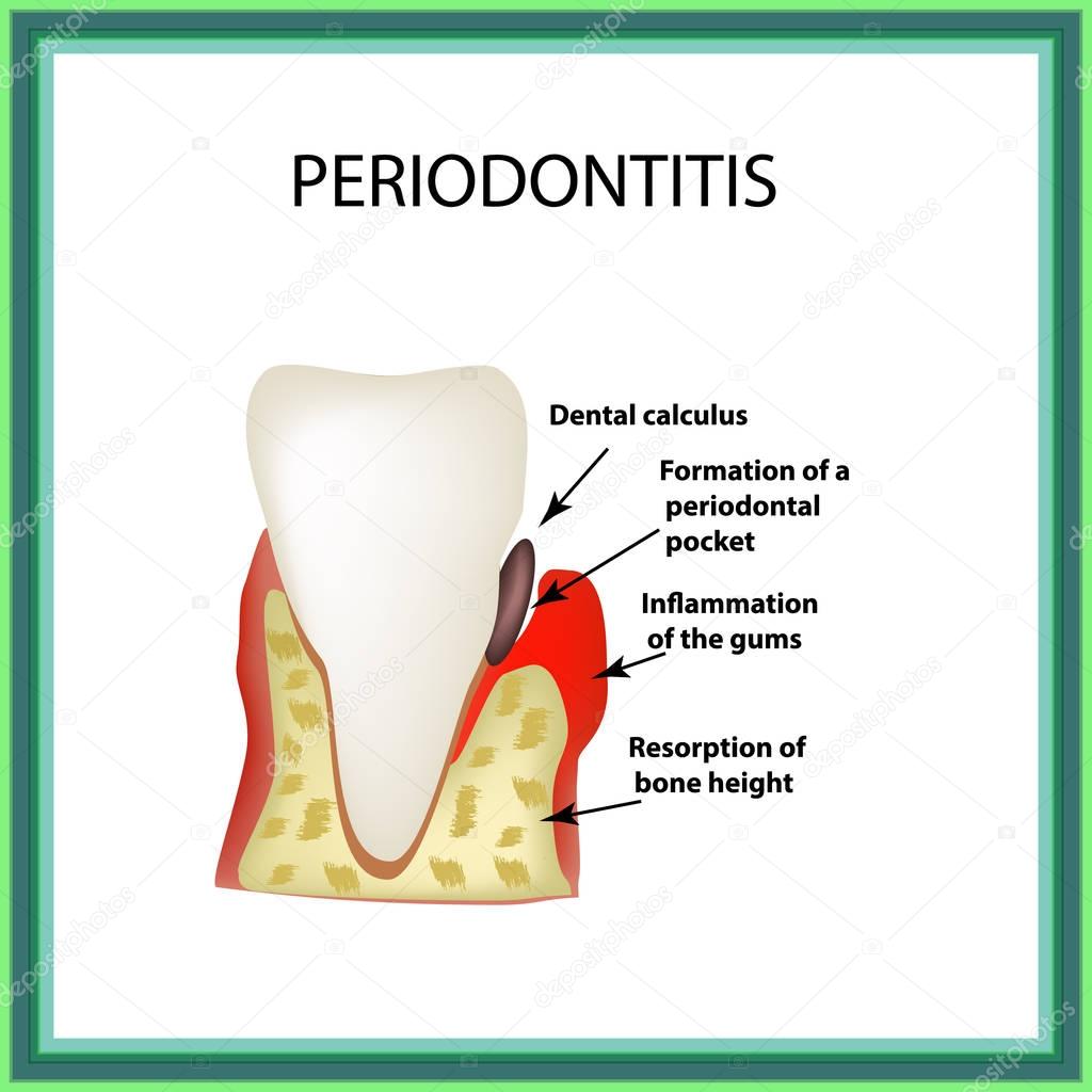 Periodontitis. dental disease. Inflammation of the gums and the tooth stone. Infographics. Vector illustration on isolated background