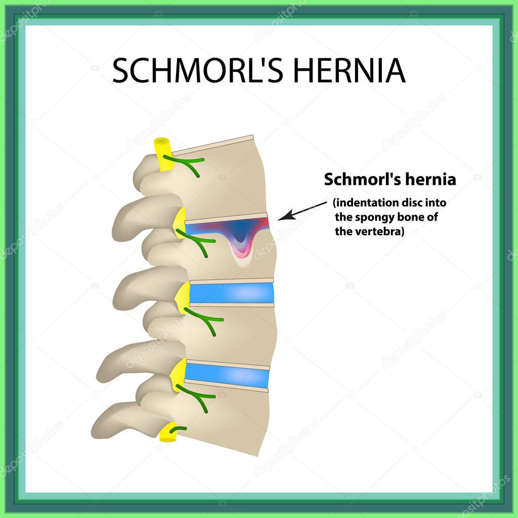 Hernia Schmorl. Intervertebral disc. Side view. Spine. Infographics