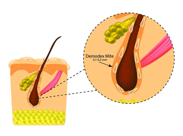 La struttura dei capelli. Ghiandola sebacea. Introduzione dell'acaro demodex. Demodecosi. Infografica. Illustrazione vettoriale su sfondo isolato — Vettoriale Stock