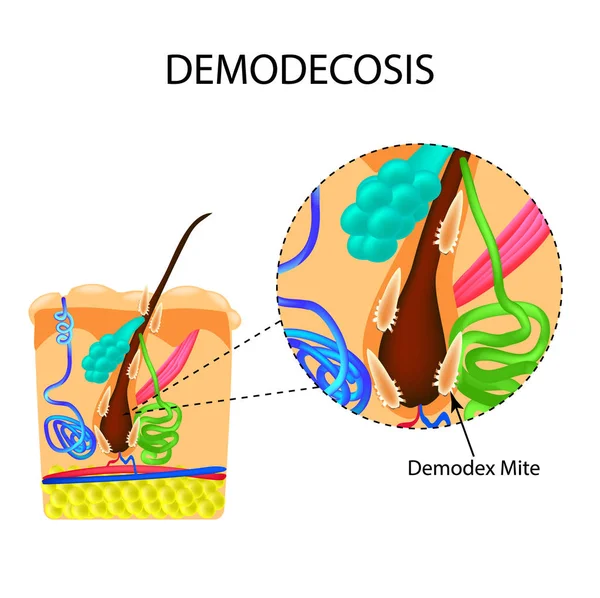 The structure of the hair. Sebaceous gland. Sweat gland. Introduction of demodex mite. Demodecosis. Infographics. Vector illustration on isolated background — Stock Vector