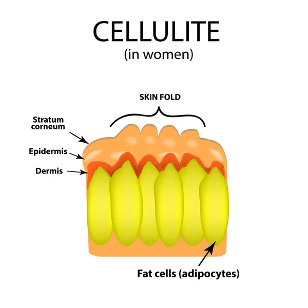 Envejecimiento de la piel en mujeres. Celulitis. Infografías. Ilustración vectorial sobre fondo aislado — Vector de stock