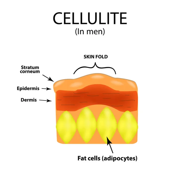 Envejecimiento de la piel en hombres. Celulitis. Infografías. Ilustración vectorial sobre fondo aislado — Archivo Imágenes Vectoriales