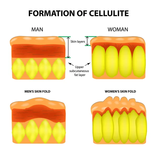 Celulite e envelhecimento da pele em homens e mulheres. Infográficos. Ilustração vetorial sobre fundo isolado —  Vetores de Stock