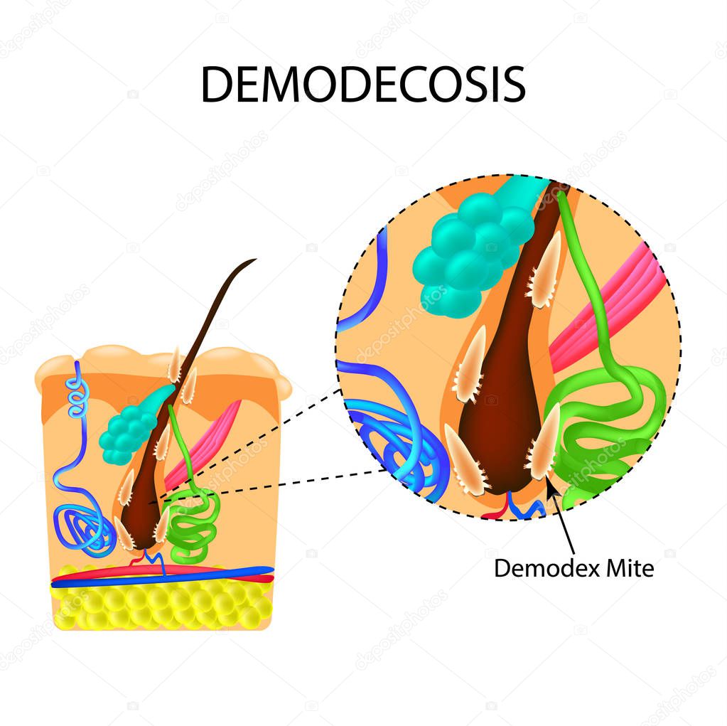 The structure of the hair. Sebaceous gland. Sweat gland. Introduction of demodex mite. Demodecosis. Infographics. Vector illustration on isolated background