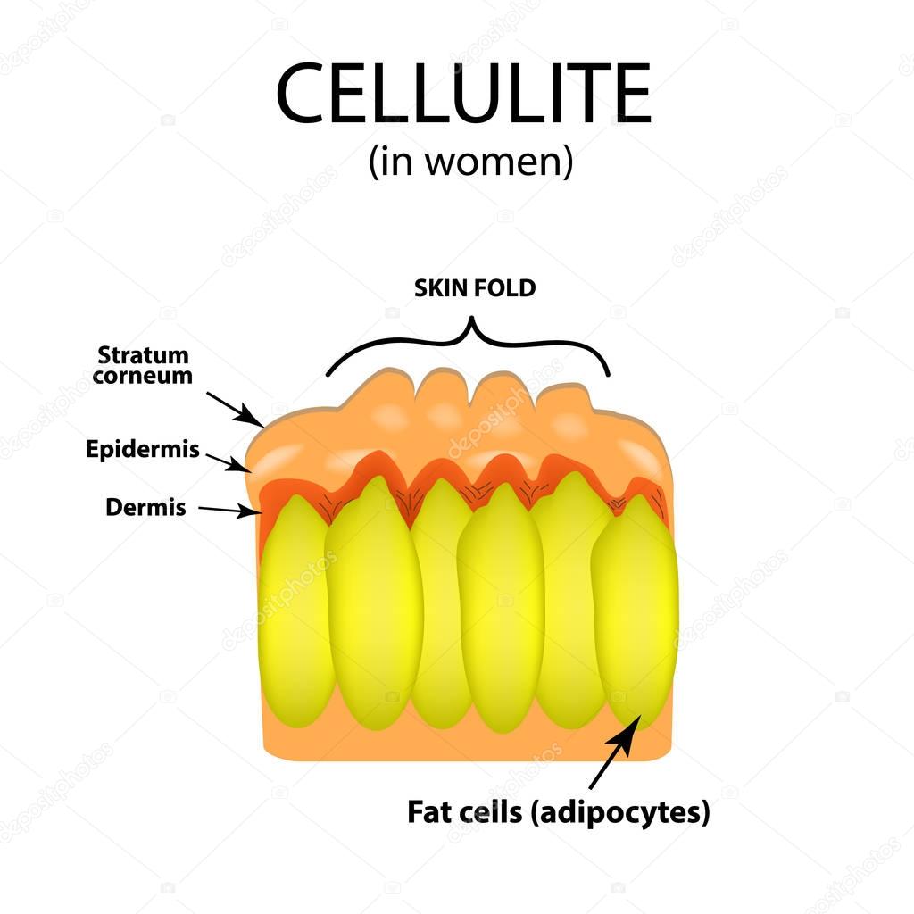 Skin aging in women. Cellulitis. Infographics. Vector illustration on isolated background