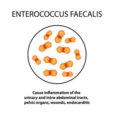 Enterococcus faecalistir. Patojenik flora. Bakteri bağırsak hastalıkları neden olur. Infographics. Vektör çizim.