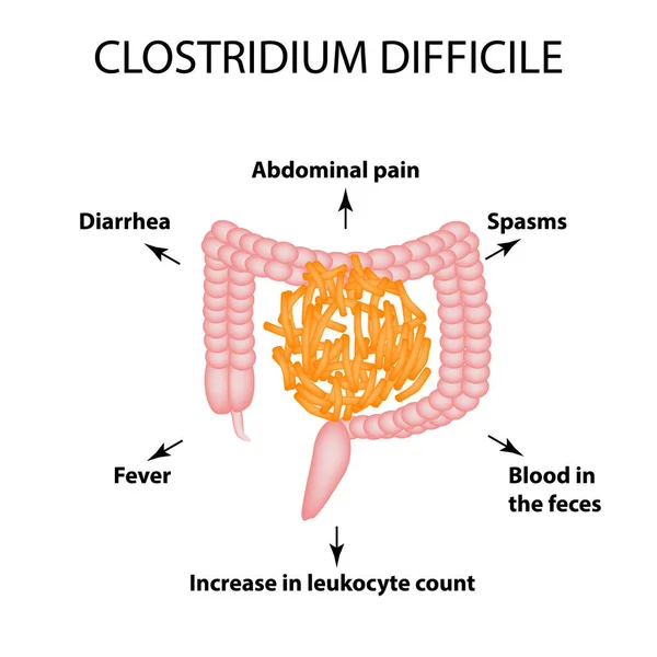 Clostridium difficile. Pathogene flora. De bacterie veroorzaakt intestinale ziekten. Symptomen van infectie. Infographics. Vectorillustratie. — Stockvector