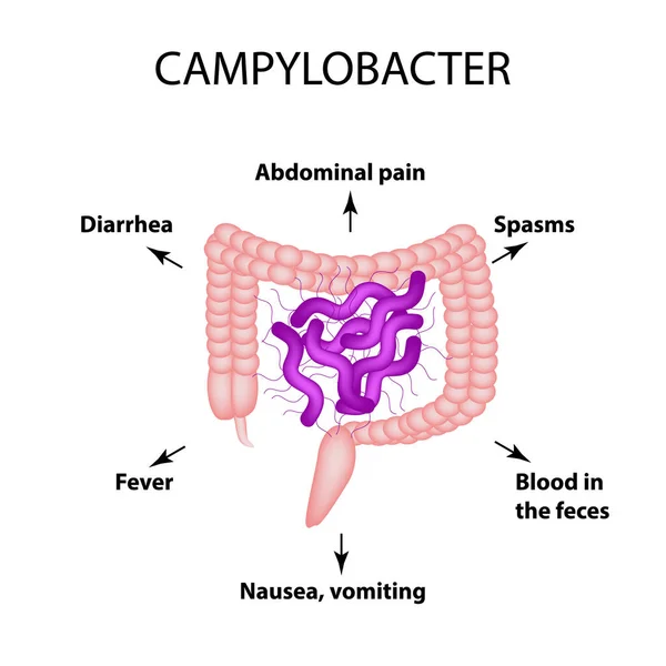 Campylobacter. Flora patógena. La bacteria causa enfermedades intestinales. Síntomas de infección. Infografías. Ilustración vectorial . — Archivo Imágenes Vectoriales