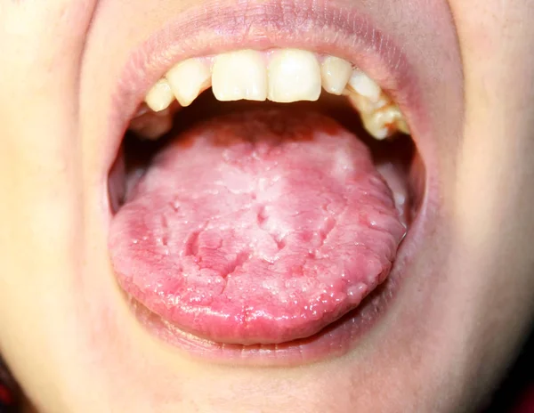 Die Zunge ist in einem weißen Raub. Candidiasis auf der Zunge — Stockfoto