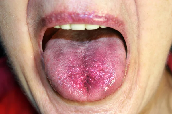 The tongue is red, inflamed. Hyperemia of the mucous membrane of the tongue — Stock Photo, Image