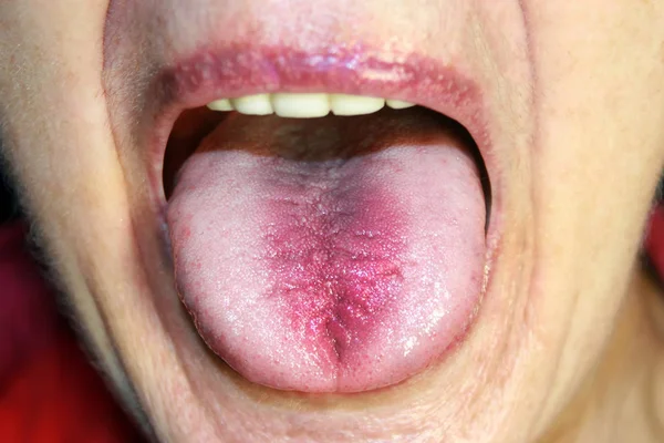 The tongue is in a white raid. Candidiasis in the tongue — Stock Photo, Image