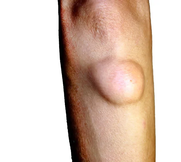 Lipoma on the elbow of the arm — Stock Photo, Image