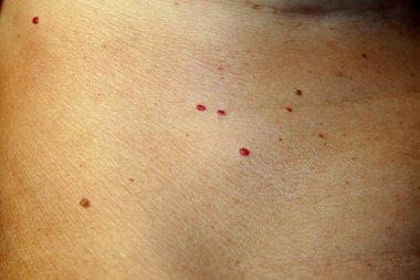 Angioma cilt üzerinde. Vücut üzerinde kırmızı benler. Pek çok doğum lekeleri.