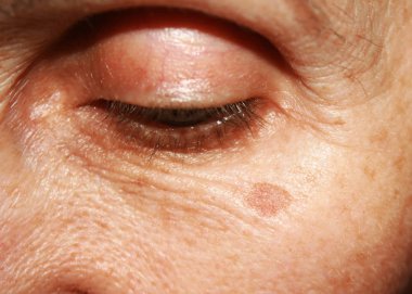 Pigmentasyon yüzünde. Kahverengi nokta. Kırışıklık göz kapağı ve göz altında
