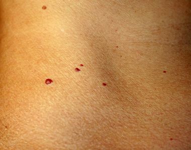 Angioma cilt üzerinde. Vücut üzerinde kırmızı benler. Pek çok doğum lekeleri.