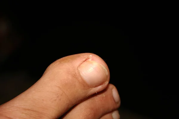 陥入爪。足の指。ペディキュア. — ストック写真