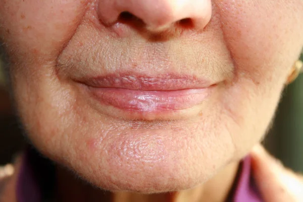 Lips. Silicone. Nasolabial folds. Wrinkles around the mouth — Stock Photo, Image