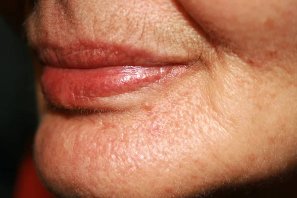 Lips. Silicone. Nasolabial folds. Wrinkles around the mouth — Stock Photo, Image