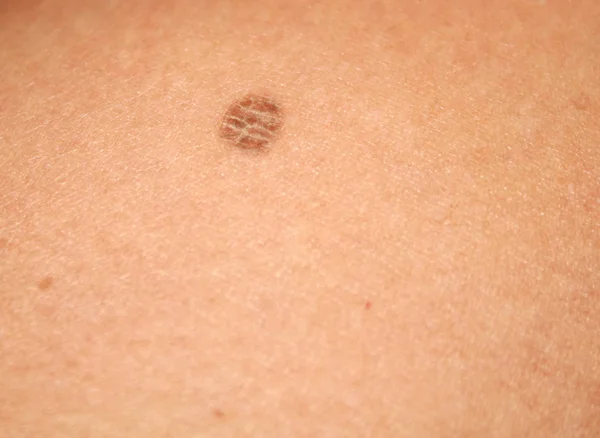 Brown spot on the body. Cracked stain. — Stock Photo, Image