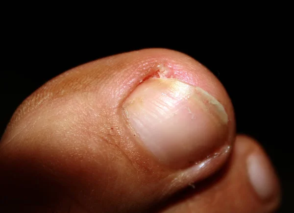 Ingrown toenail. Fingers on the foot. Pedicure. — Stock Photo, Image