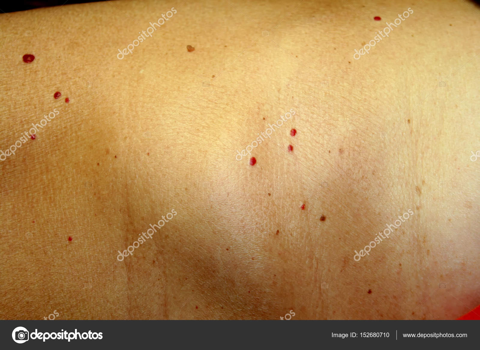 Angioma On The Skin Red Moles On The Body Many Birthmarks Royalty Free Photo Stock Image By C Mikrostoker 152680710