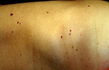 Angioma cilt üzerinde. Vücut üzerinde kırmızı benler. Pek çok doğum lekeleri.
