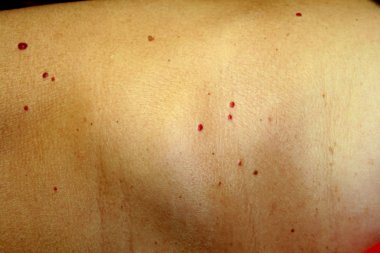 Angioma cilt üzerinde. Vücut üzerinde kırmızı benler. Pek çok doğum lekeleri.