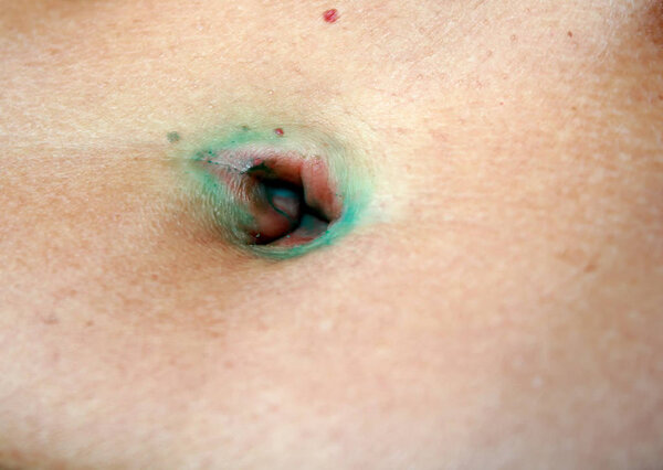 Inflammation of the navel. Furuncle. Abscess. Infection.
