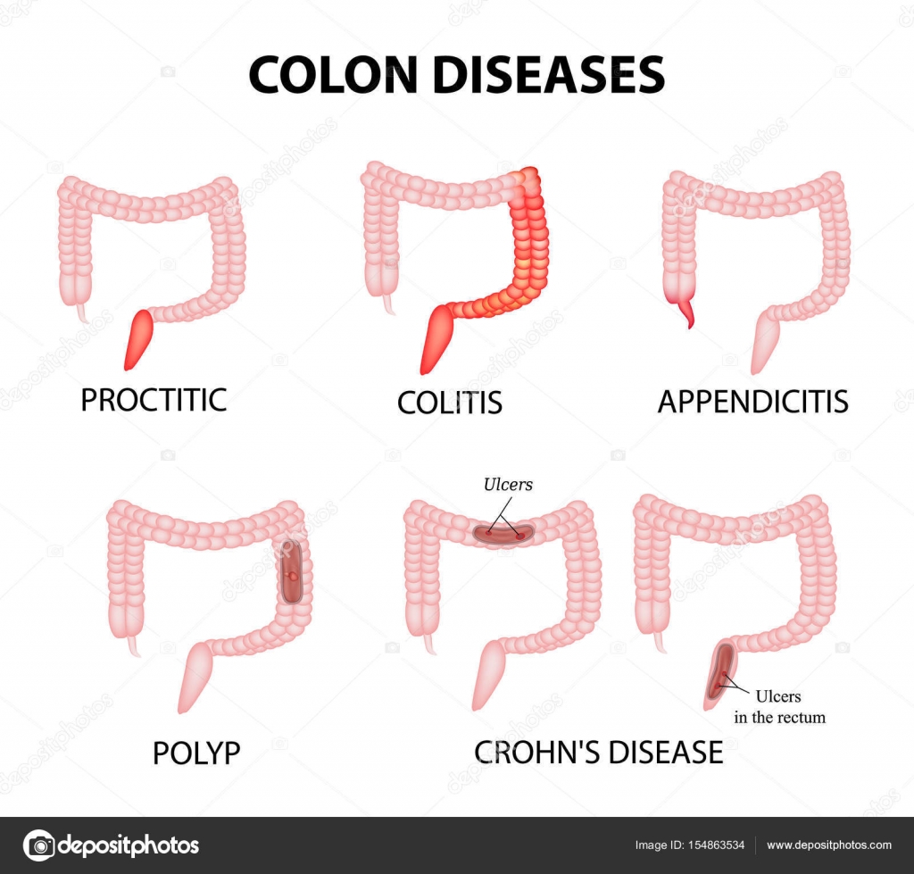 Стул при аппендиците. Аппендикулярный колит. Болезнь крона и колит проктит. Болезнь крона аппендицит.