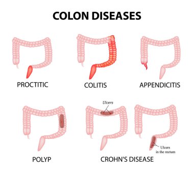 Kolon hastalıkları. Proktit, kolit, apandisit, polip, ülser, Crohn hastalığı. Infographics. Vektör illüstrasyon izole arka plan üzerinde