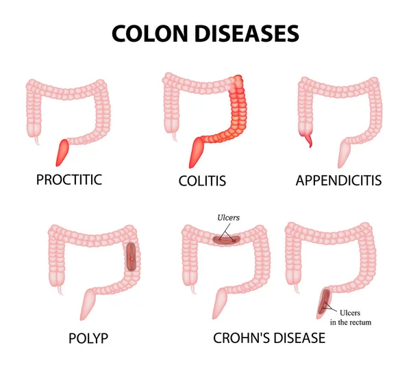 Doenças do cólon. Proctite, colite, apendicite, pólipo, úlcera, doença de Crohn. Infográficos. Ilustração vetorial sobre fundo isolado — Vetor de Stock