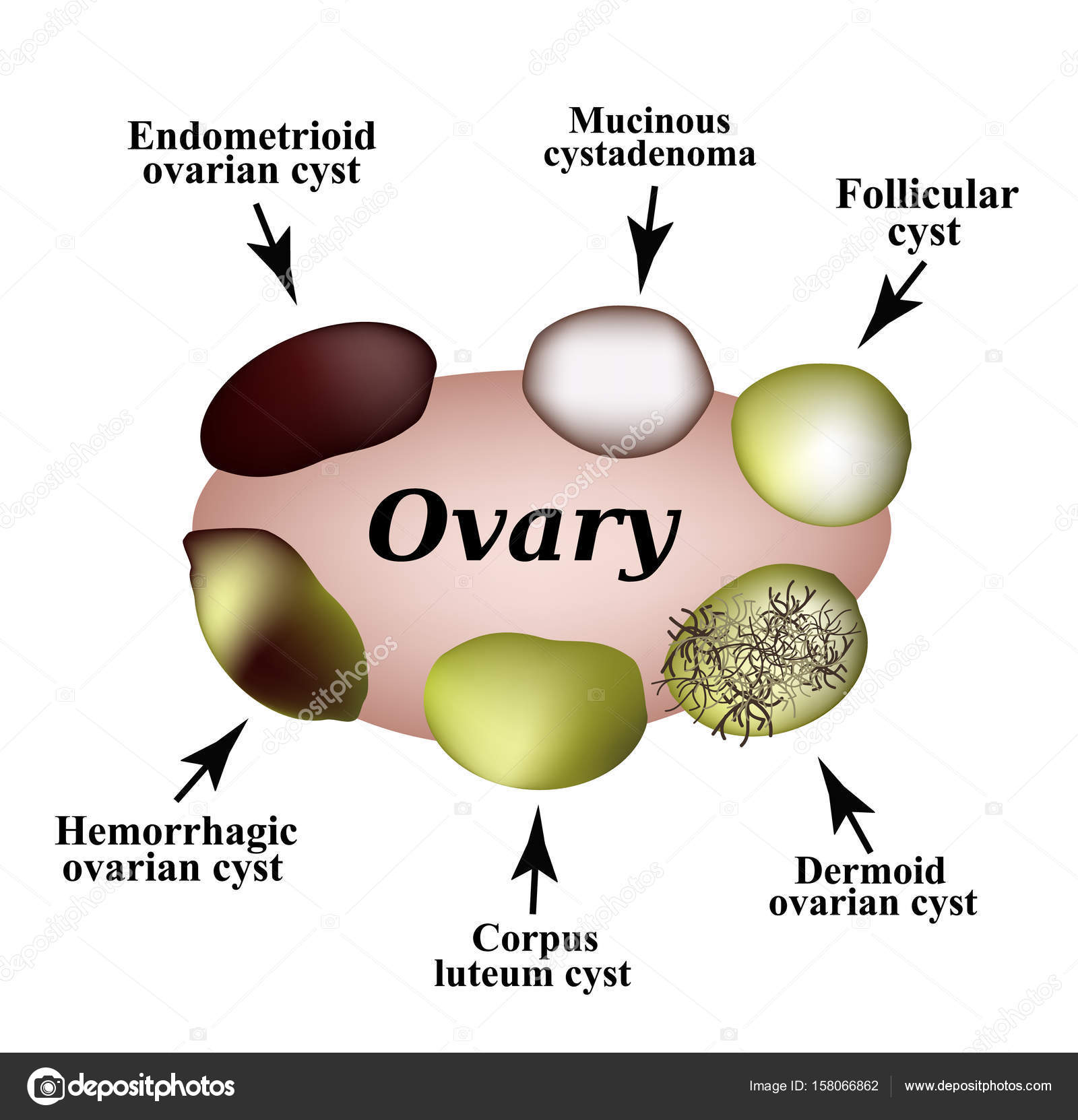 Ovarian Cyst Size Chart