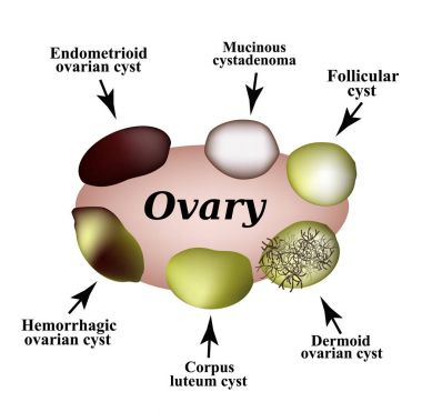 Types of ovarian cysts. Set. Infographics. Vector illustration on isolated background. clipart