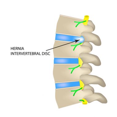 İntervertebral disk fıtığı. Vektör illüstrasyon izole arka plan üzerinde.