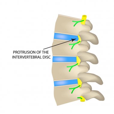 İntervertebral disk çıkıntı. Vektör illüstrasyon izole arka plan üzerinde