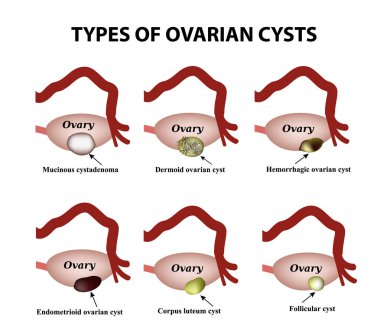 Types of ovarian cysts. Set. Infographics. Vector illustration on isolated background clipart