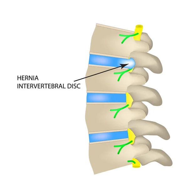 Una hernia del disco intervertebral. Ilustración vectorial sobre fondo aislado . — Archivo Imágenes Vectoriales