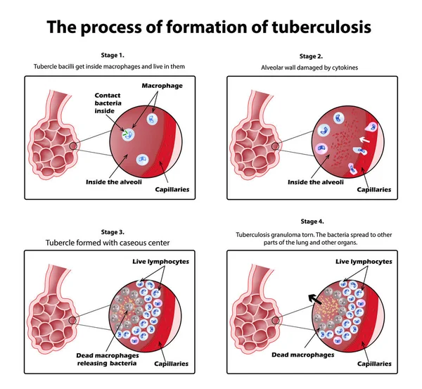 Процес формування туберкульозу. Інфографіка. Векторні ілюстрації на ізольованому фоні . — стоковий вектор